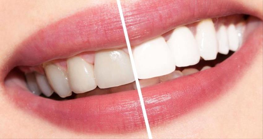 أسباب اصفرار الأسنان وكيفية علاجه وتنظيف الأسنان طبيعيا