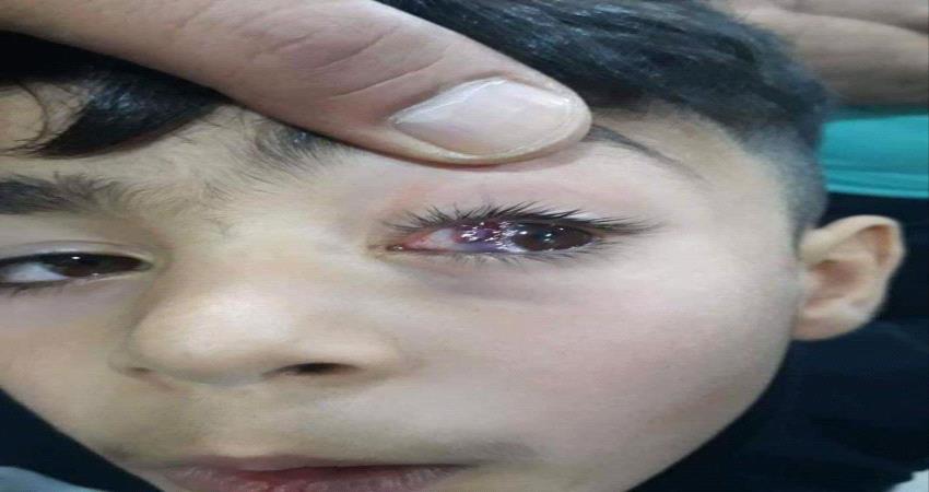 20 حالة إصابة بمسدسات الخرز معظمهم اطفال في عدن
