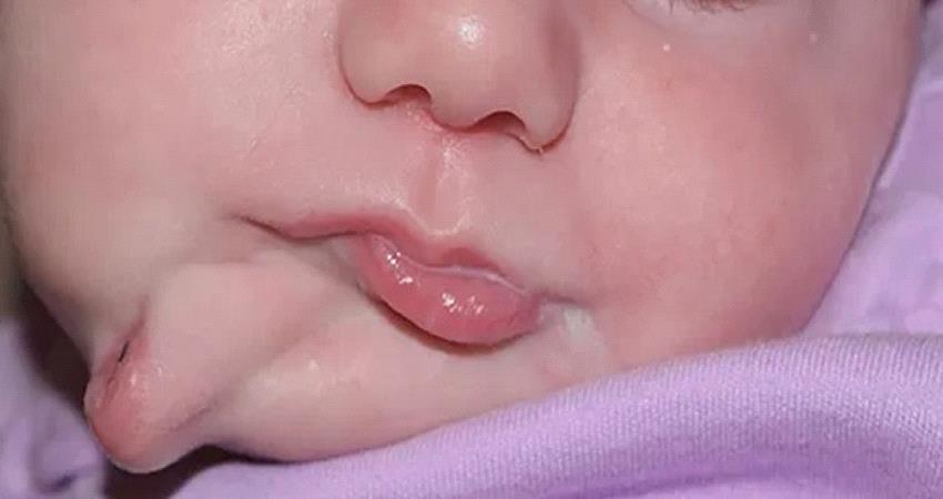 طفلة تولد بفمين في حالة نادرة "صور" 